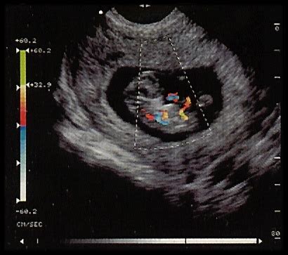 Also have retroverted uterus, I had a transvaginal at 6 weeks (I think I measured 66 that day) where they heard the heartbeat. . Misdiagnosed miscarriage tilted uterus
